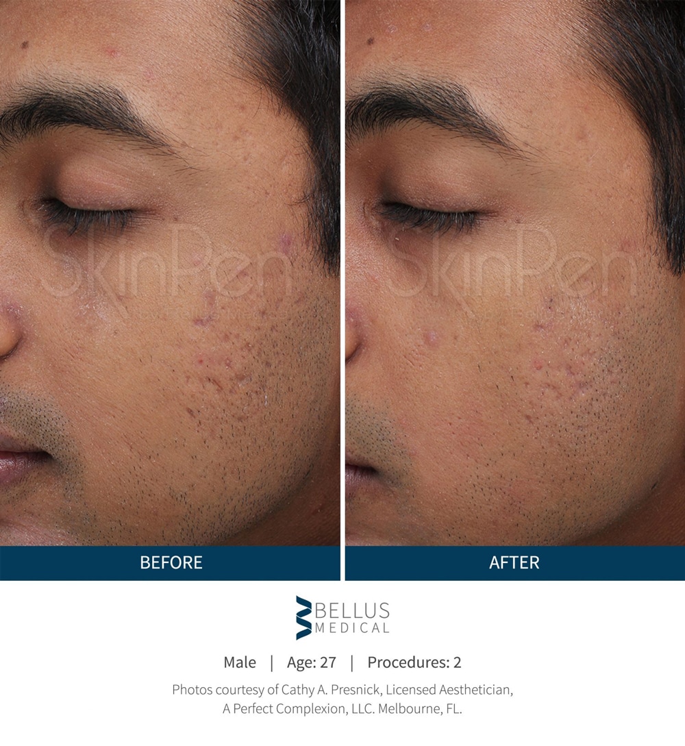 microneedling SkinPen treatment before and after