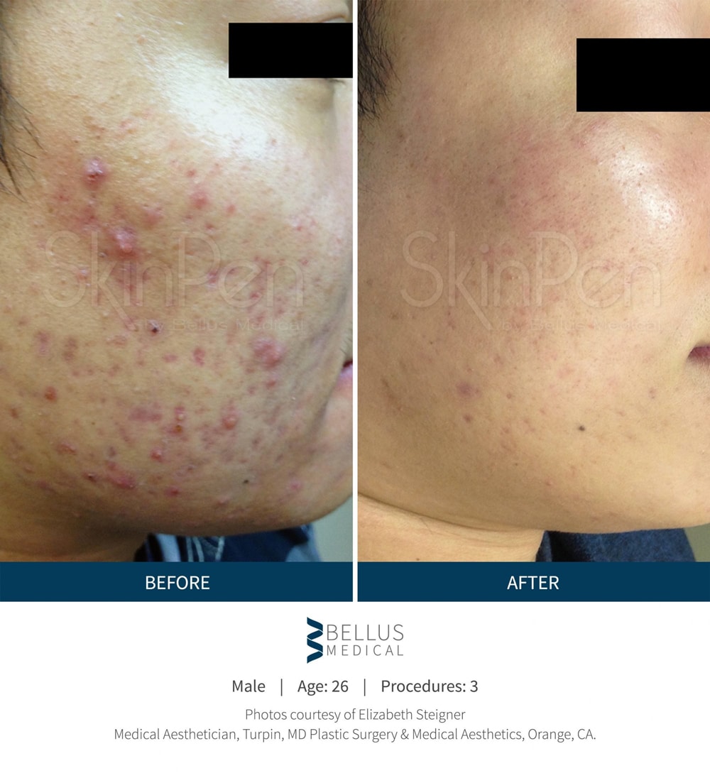 microneedling SkinPen treatment before and after