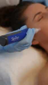Woman receiving microneedling treatment at Olakino Laser + Skin in Victoria