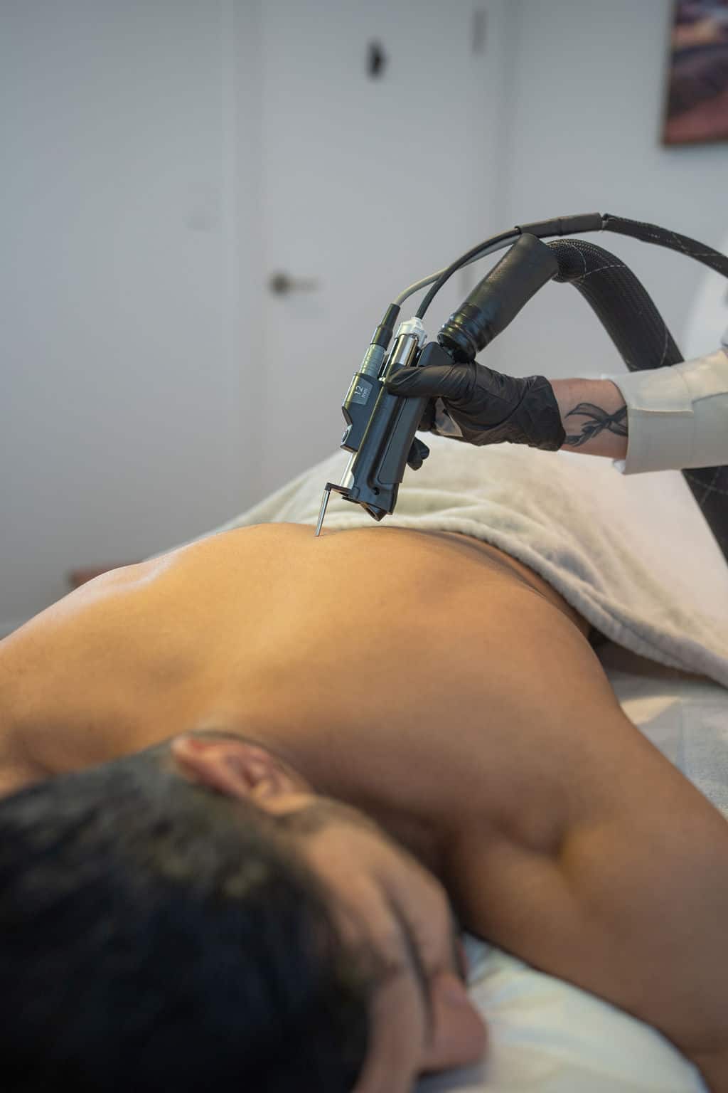 Laser hair removal for dark skin Victoria