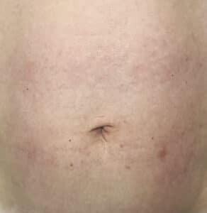 Stomach after postpartum skin tightening laser treatment