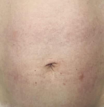 Stomach after postpartum skin tightening laser treatment
