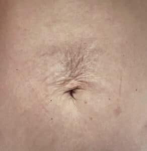 Stomach before postpartum skin tightening laser treatment