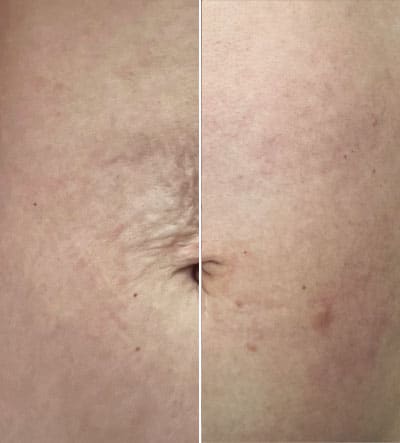 tummy tightening