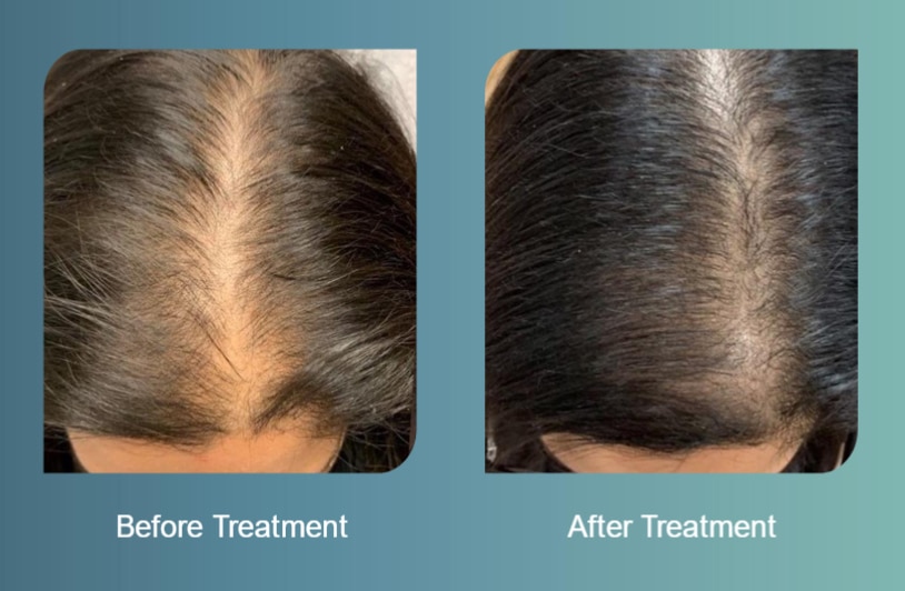 Before After Hair Restoration Before After Hair Restoration