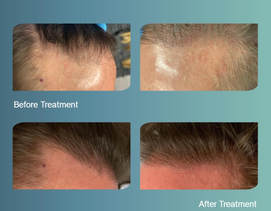 Before and After hair restoration treatment Before and After hair restoration treatment