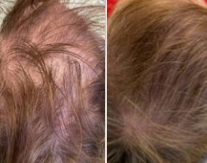 Hair Restoration
