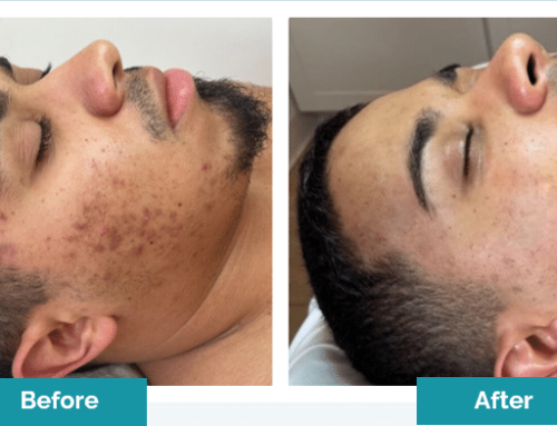 Microneedling for Acne Scars: How SkinPen Helps Improve Skin Texture
