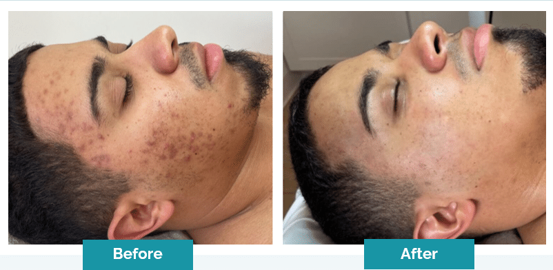SkinPen acne scar treatment Victoria