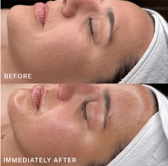 Hydrafacial Victoria BC